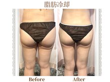 モテスリム/脂肪冷却 お尻2カップ