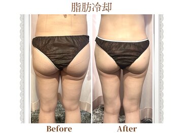 モテスリム/脂肪冷却 お尻2カップ