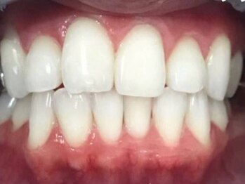 ホワイトニングサロン ビアンカ 浜松浜北店(BIANCA)/【ホワイトニングされたお客様】