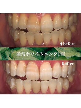 フタバ 天神大名店(futaba)/初回ホワイトニングbefore after