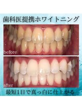 ホワイトニングビューティー つくば店/圧倒的効果を実感！