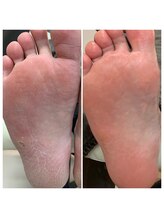 ニコ(niko)/足裏のガサガサを綺麗に