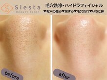 シエスタ(siesta)/毛穴洗浄ブーム到来