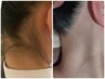 【痛みの少ない最新脱毛】体験10ショット　¥550