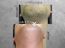 ル シャ/メンズ脱毛/毛穴洗浄/ヘッドスパ