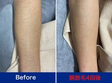 ミスターアンクール 鹿児島(Mr.uncoeur)/腕脱毛4回後