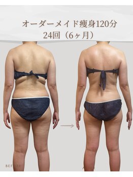 アメリオ(Amelio)/オーダーメイド痩身　24回