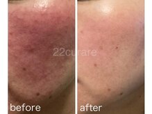 22クラレ(22curare)/美素肌エステ＋ホームケア
