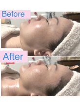 リシェカ(Richeka)/光フェイシャル