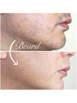 美学の写真/最先端のマシン使用☆男性のムダ毛ケアにも◎効果をお試しくださいませ！