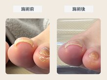 ルポ 伊勢/巻き爪ケアと肥厚爪ケア