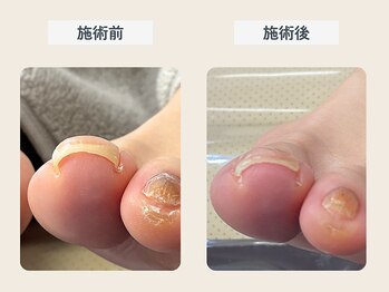 ルポ 伊勢/巻き爪ケアと肥厚爪ケア