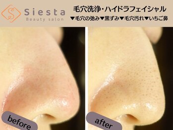 シエスタ(siesta)/毛穴洗浄ブーム到来