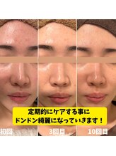 ビアル(VIALU)/ハーブピーリング♪肌質改善