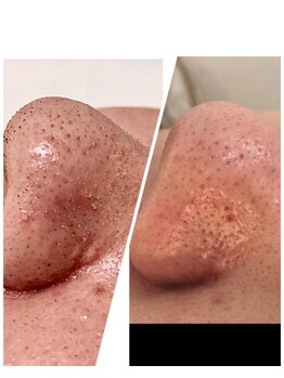 カランコエ(KALANCHOE)/鼻の詰まり毛穴(左：前　右：後)