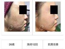 SDルーム/リベルハーブピーリング