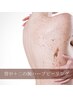 【ブツブツ/黒ずみなどに◎】背中美人へ☆背中＋二の腕ハーブピーリング