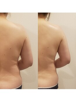 トータルエステティック ジョワイユ(JOYEUX)/二の腕集中ケア