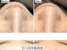 フレイヤ(FREYA)/毛穴専科Before→After