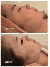 サロンド シェリー(Salon de Cherie)/ハーブピーリング