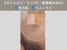 アンジュ(ANGE)/ガリレオピーリング症例