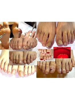 爪の悩みを解消できる（ケア含む）