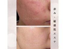 敏感肌や赤みでお悩みの方。取りすぎないケアでお肌のバリア回復