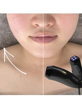 ラウレア(Laule'a)/津山｜小顔・左右比較