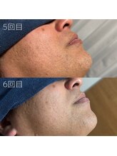 カナウ(KANAU)/ヒゲ脱毛（40代前半男性）