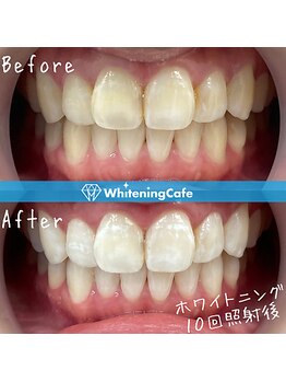 ホワイトニングカフェ 和歌山ガーデンパーク店(WhiteningCafe)/16分×2回照射/5回来店/20代女性
