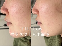 ザ フロウ(THE flow)/プラズマで人中縮小