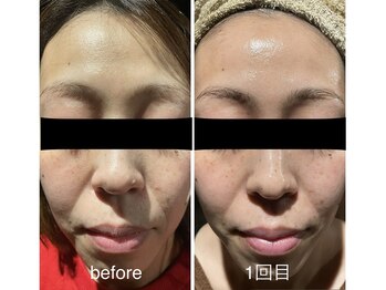 ネムズヴェリタ(nemu's Verita)の写真/たるみ・シワ・美白・色素沈着・毛穴ケア・エイジングケアにはマイクロニードルピーリング