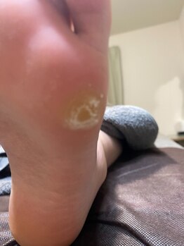 グリーングリーン(GREEN GREEN)/硬いタコを除去before