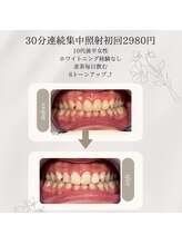 プラスビーセルフ(+b self)/ホワイトニングビフォーアフター