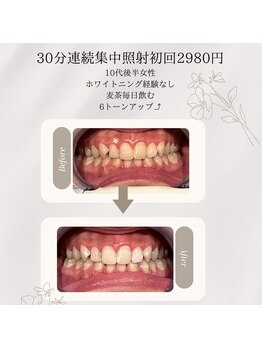 プラスビーセルフ(+b self)/ホワイトニングビフォーアフター