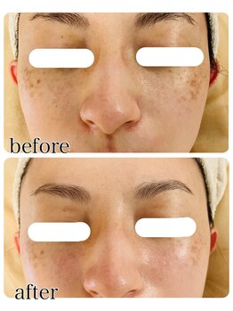 ニコリ(nicori)/乳酸ピーリングbeforeとafter