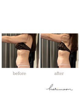 ハリムーン 仙台(harimoon)/美ボディコースビフォーアフター