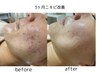 【何しても凸凹跡・毛穴悩み解決しなかった方】毛穴パーソナルフェイシャル☆
