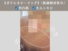 アンジュ(ANGE)/ガリレオピーリング症例