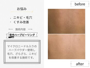 シロ(CHILO)/背中ハーブピーリング