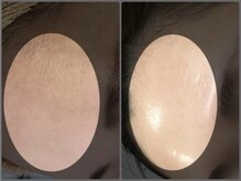 パリスヒロトン(PARIS HIROTON)/HAABリプロ (ハーブピーリング)