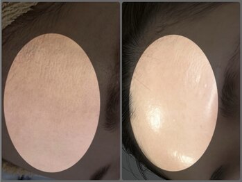 パリスヒロトン(PARIS HIROTON)/HAABリプロ (ハーブピーリング)