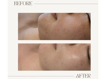 ミジタク 京都二条店(mijitaku)/ハーブピーリング3回目のお肌