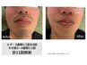 【男性】ひげ脱毛　30分　￥3,000