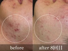 REON the BEAUTYの雰囲気(しつこいニキビも原因を知って綺麗に◎)