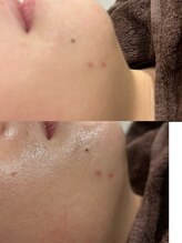 ツール(TOOL)/ハーブピーリング