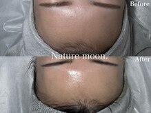 ナチュールムーン(Nature moon.)/ハーブピーリング