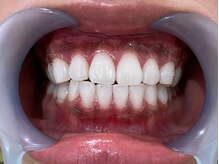 ホワイトニングサロン ビアンカ 浜松浜北店(BIANCA)/【ホワイトニングされたお客様】