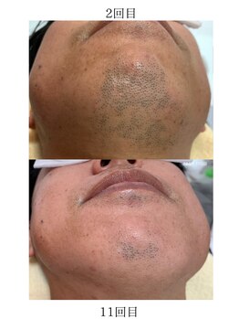 ティーニ 小牧店(TINI)/≪before→after≫