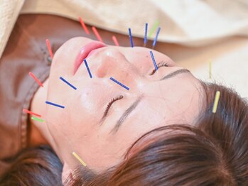 すばる屋の写真/鍼と灸で根本原因にアプローチ！美容鍼でフェイスラインのもたつき/トーンアップ/目の開き等の改善も◎